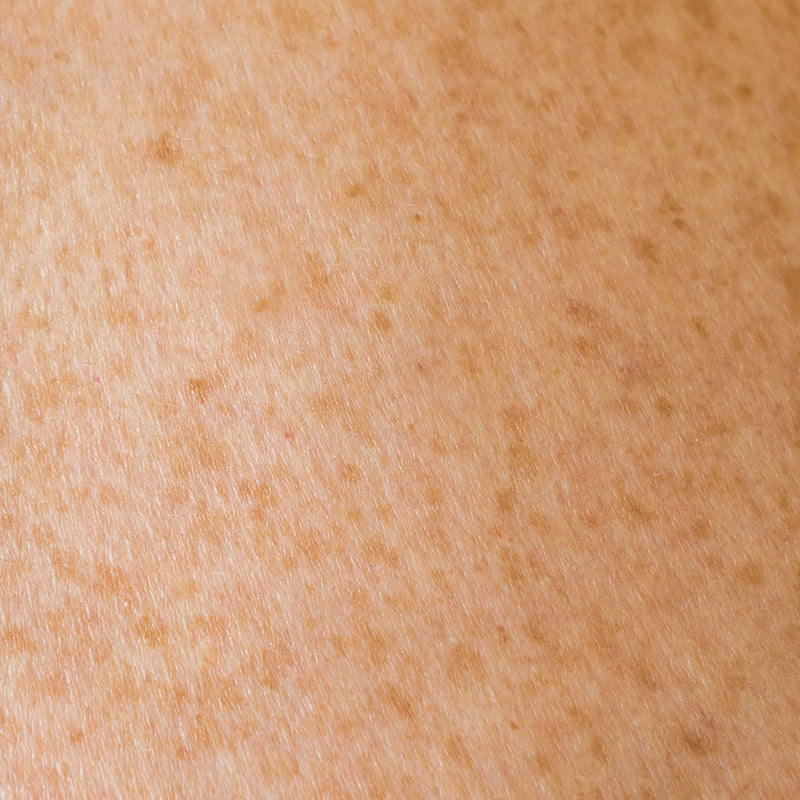 ¿Por qué se forman manchas en la piel?